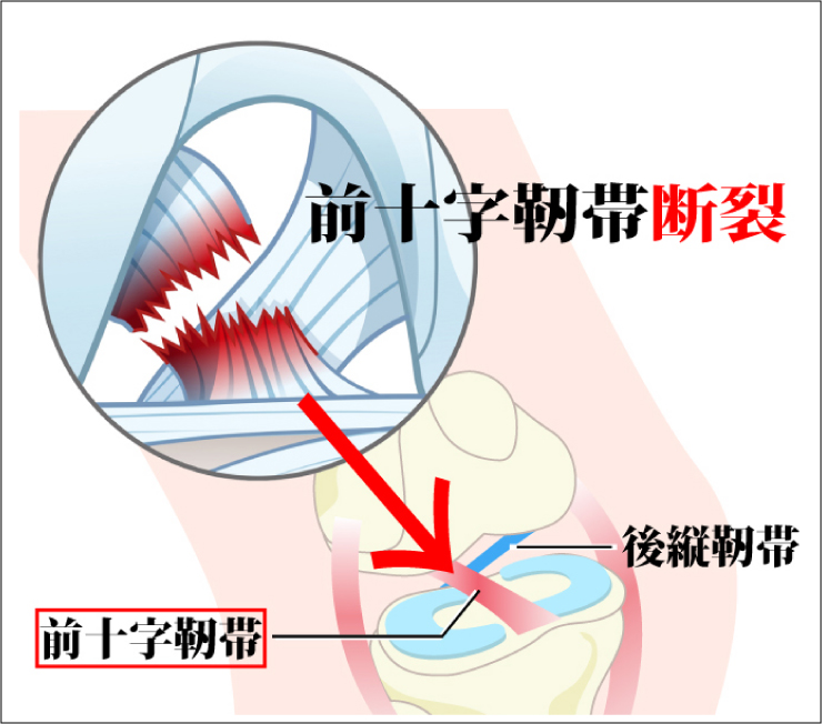 膝じん帯断裂